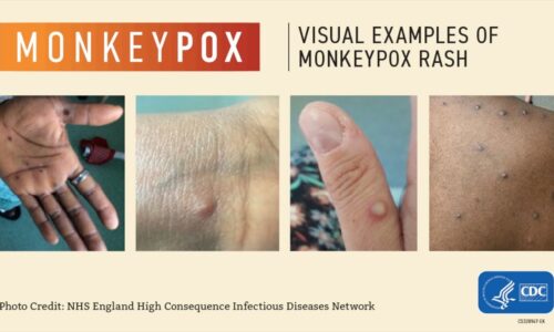 Monkeypox FAQ